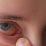 Swelling of the eye