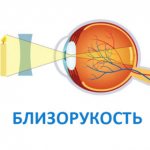 Differences between astigmatism and myopia (myopia)