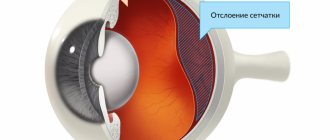 retinal disinsertion