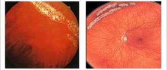 Peripheral retinal dystrophy