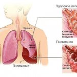 пневмония симптомы