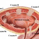 Полипы в мочевом пузыре у мужчин: симптомы, лечение и удаление