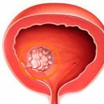 Полипы в мочевом пузыре у мужчин: симптомы, лечение и удаление
