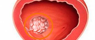 Polyps in the bladder in men: symptoms, treatment and removal