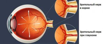 Causes of glaucoma and prevention