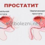 Prostatitis - inflammation of the prostate in a man
