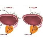 Рак предстательной железы стадии развития
