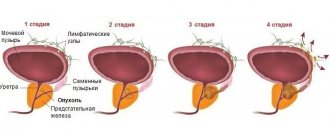 Рак предстательной железы стадии развития