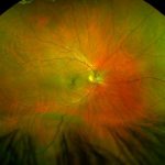 Retinal dissection