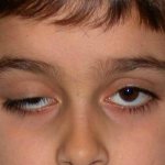 Marcus Gunn syndrome in a boy
