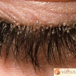 accumulation of lice and nits on eyelashes