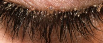 accumulation of lice and nits on eyelashes