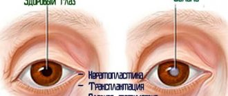 ways to treat cataract