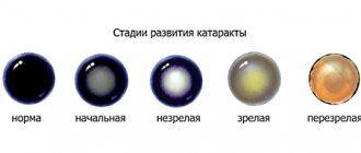 Cataract stages