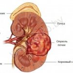 Structure of a kidney with a tumor