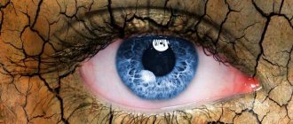 Сухой кератоконъюнктивит также называют синдромом «сухого глаза»
