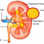 Removal of a kidney cyst