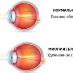 elongation of the eyeball along the anteroposterior axis