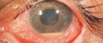 Uveitis in children - causes, symptoms and treatment (photos)