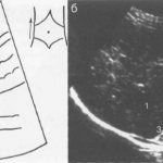 Ultrasound of the right adrenal gland, longitudinal scanning