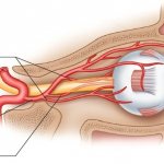 Varicose veins of the eye veins