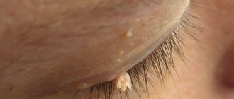 Types and causes of warts on the eyelid