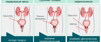types of urinary incontinence in men
