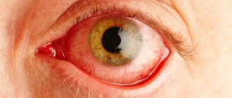 inflammation of the conjunctiva