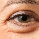 Inflammation of the lower eyelid