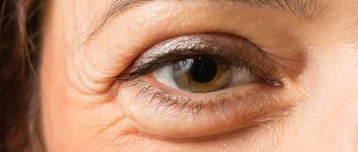 Inflammation of the lower eyelid