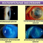 Ulcerative lesions of the eye