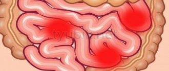 Intestinal colitis disease