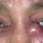 Blocked tear duct - causes and treatment