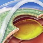 Eye lens replacement