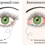 Healthy eye and conjunctivitis