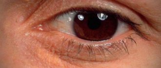 Yellow spots under the eyes. There are yellow spots on the eyelids under the eyes - oh, what disease are they talking about? 